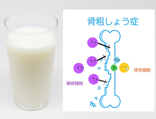 牛乳で骨粗鬆症になる理由