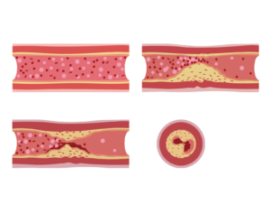 動脈硬化症